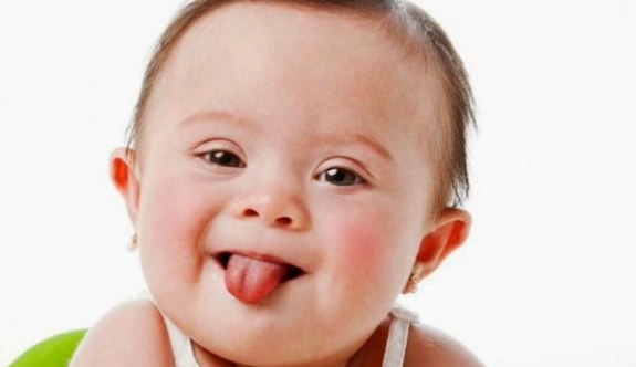 Her 800 bebekten biri down sendromu ile dünyaya geliyor