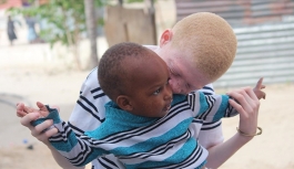 Afrikalı Albinolar 'Beyaz' Bir Gelecek Ümidiyle Yaşıyor