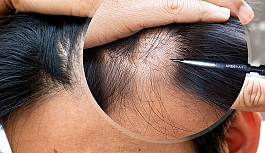 Tabipler Birliği: Çalışma izni olmadan saç ekimi yapanlar tespit edildi!